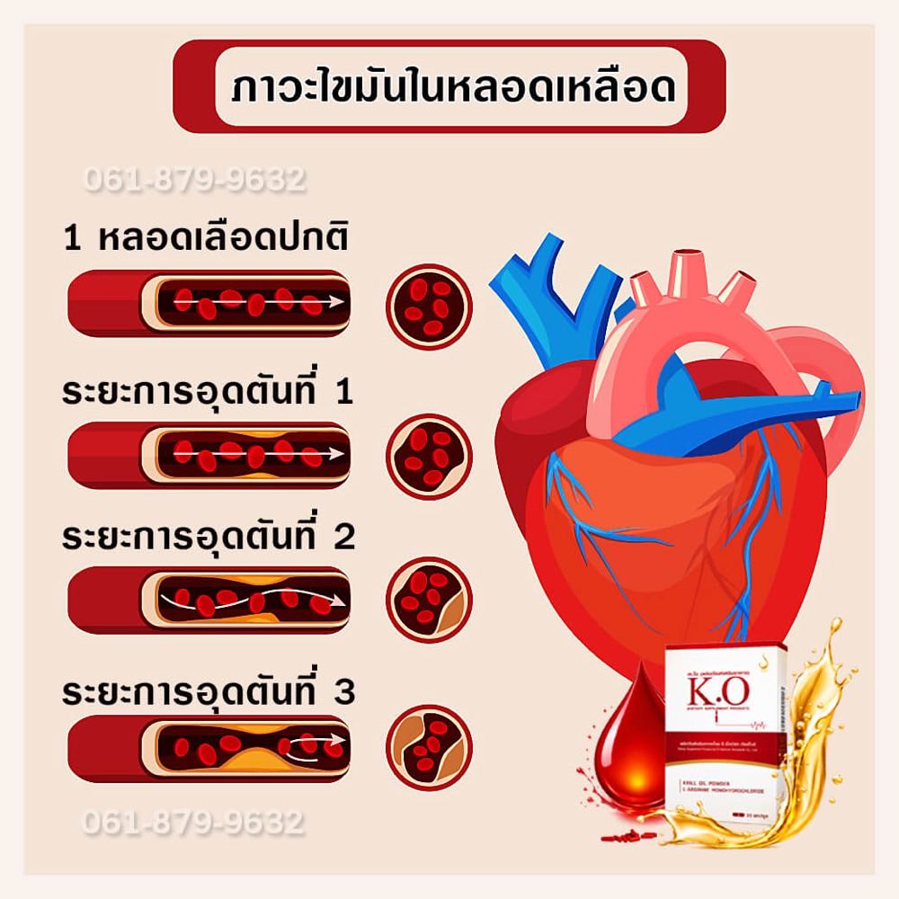 ไขมันในเลือดสูง